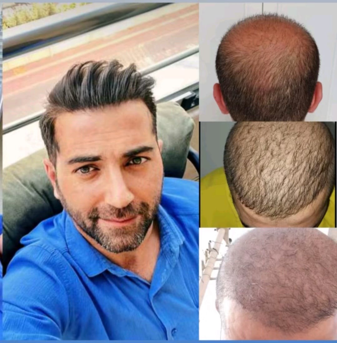 From Balding to healthy Hair