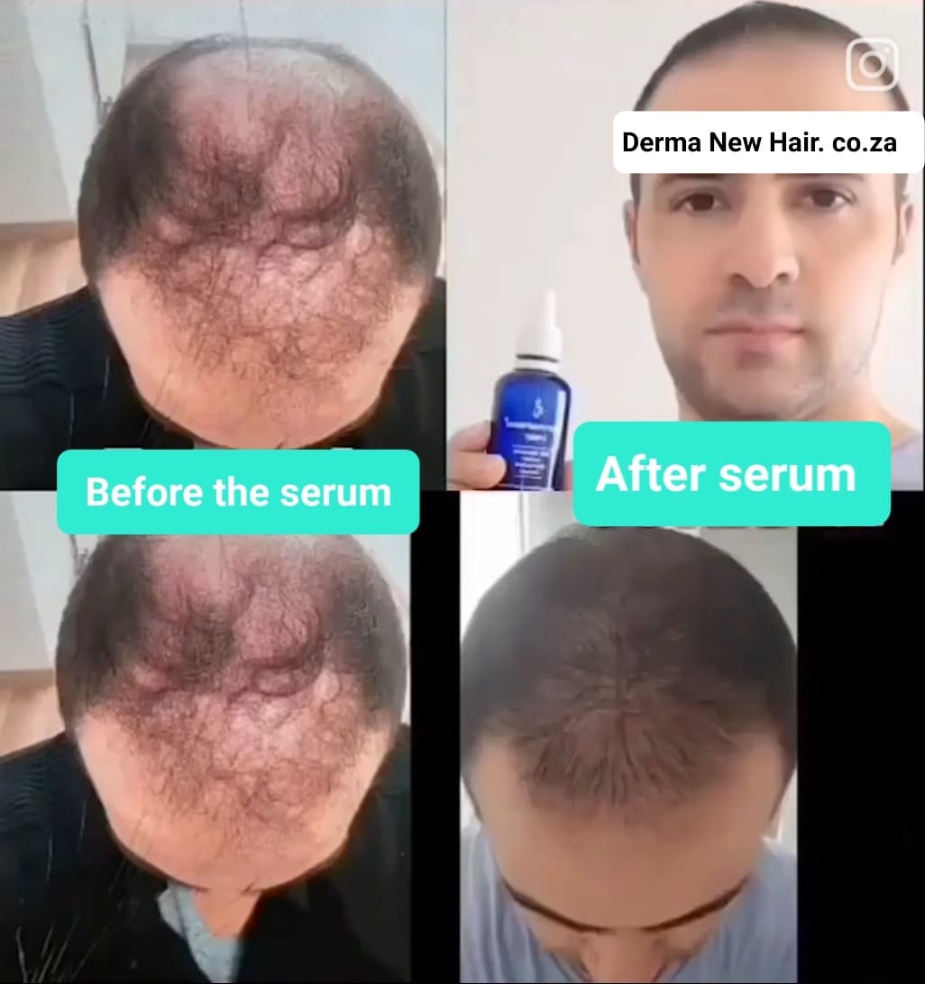 Male Pattern Baldness